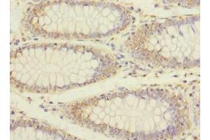Immunohistochemistry of paraffin-embedded human colon cancer using ABIN7151990 at dilution of 1:100 (ERBB2IP antibody  (AA 1193-1412))