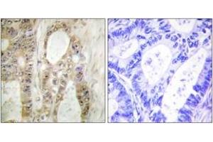 Immunohistochemistry analysis of paraffin-embedded human colon carcinoma, using Chk1 (Ab-296) Antibody. (CHEK1 antibody  (AA 266-315))