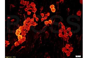 Formalin-fixed and paraffin embedded human oral squamous cell carcinoma labeled with Anti-laminin Polyclonal Antibody, Unconjugated (ABIN728638) at 1:200, followed by conjugation to the secondary antibody. (Laminin antibody  (AA 901-1000))