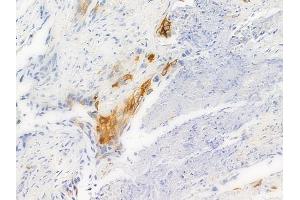 ABIN6256149 and ABIN6267294 at 1/100 staining human lung squamous cell carcinoma by IHC-P. (HSP27 antibody  (pSer15))