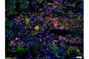 Formalin-fixed and paraffin-embedded human rectal carcinoma labeled with Anti-Spindly/CCDC99 Polyclonal Antibody, Unconjugatedused at 1:200 dilution for 40 minutes at 37°C. (CCDC99 antibody  (AA 401-500))