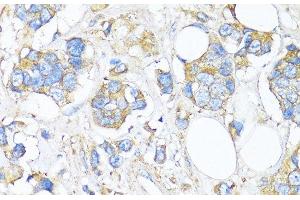 Immunohistochemistry of paraffin-embedded Human breast cancer using TIMP2 Polyclonal Antibody at dilution of 1:150 (40x lens).