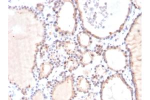 Formalin-fixed, paraffin-embedded human Prostate Carcinoma stained with Lactoylglutathione Lyase Mouse Monoclonal Antibody (CPTC-GLO1-3). (GLO1 antibody)