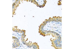 Immunohistochemistry of paraffin-embedded human prostate using VEGFC antibody at dilution of 1:100 (40x lens). (VEGFC antibody)