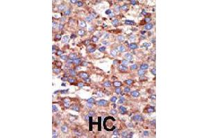 Formalin-fixed and paraffin-embedded human hepatocellular carcinoma tissue reacted with YY1 polyclonal antibody  , which was peroxidase-conjugated to the secondary antibody, followed by DAB staining . (YY1 antibody  (Internal Region))