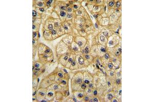 Formalin-fixed and paraffin-embedded human hepatocarcinoma with A2 Antibody (Center), which was peroxidase-conjugated to the secondary antibody, followed by DAB staining. (AP2A2 antibody  (AA 610-637))