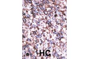 Formalin-fixed and paraffin-embedded human cancer tissue reacted with the primary antibody, which was peroxidase-conjugated to the secondary antibody, followed by AEC staining. (BACE2C antibody  (C-Term))