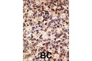 Formalin-fixed and paraffin-embedded human breast cancer tissue reacted with JAG2 polyclonal antibody  , which was peroxidase-conjugated to the secondary antibody, followed by DAB staining.