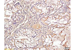 Formalin-fixed and paraffin embedded human rectal carcinoma labeled with Rabbit Anti TIMP-1 Polyclonal Antibody, Unconjugated (ABIN707441) at 1:200 followed by conjugation to the secondary antibody and DAB staining (TIMP1 antibody  (AA 131-207))