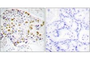 Immunohistochemistry analysis of paraffin-embedded human lung carcinoma tissue, using Retinoblastoma (Ab-249) Antibody. (Retinoblastoma Protein (Rb) antibody  (AA 211-260))