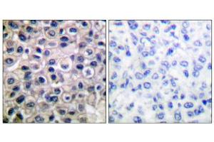 Immunohistochemical analysis of paraffin-embedded human breast carcinoma tissue using MMP-14 antibody (ABIN5976458). (MMP14 antibody  (C-Term))