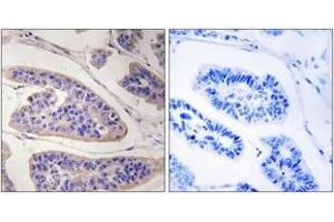 Immunohistochemistry analysis of paraffin-embedded human breast carcinoma tissue, using ENAH Antibody. (ENAH antibody  (AA 472-521))