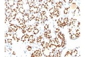 Formalin-fixed, paraffin-embedded human thyroid stained with TTF1 antibody (8G7G3/1 + NX2. (TTF1 antibody)