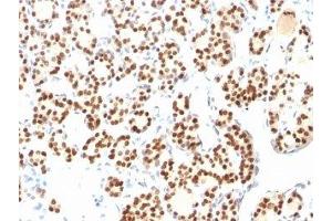 Formalin-fixed, paraffin-embedded human thyroid stained with TTF1 antibody (8G7G3/1 + NX2.