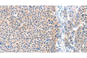 Immunohistochemistry of paraffin-embedded Human liver cancer tissue using ADAM20 Polyclonal Antibody at dilution 1:50 (ADAM20 antibody)