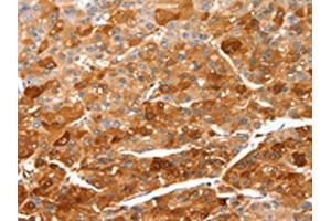 The image on the left is immunohistochemistry of paraffin-embedded Human liver cancer tissue using ABIN7128947(CIDEC Antibody) at dilution 1/50, on the right is treated with fusion protein. (CIDEC antibody)