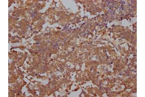 IHC image of ABIN7127851 diluted at 1:100 and staining in paraffin-embedded human lung cancer performed on a Leica BondTM system. (Recombinant Topoisomerase II alpha antibody)