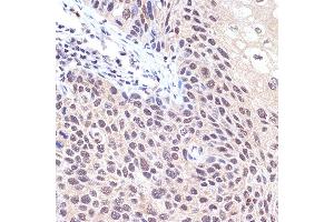 Immunohistochemistry of paraffin-embedded human esophageal cancer using Transportin 3 (Transportin 3 (TNPO3)) Rabbit mAb (ABIN7270971) at dilution of 1:100 (40x lens). (Transportin 3 antibody)