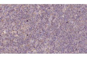 ABIN6273144 at 1/100 staining Human lymph cancer tissue by IHC-P. (NDUFB11 antibody  (N-Term))