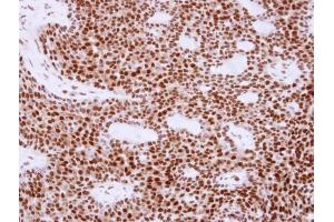 IHC-P Image Immunohistochemical analysis of paraffin-embedded human lung cancer, using APE1, antibody at 1:250 dilution.
