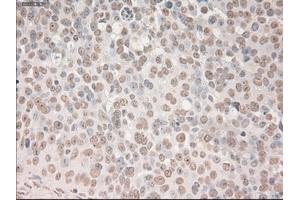 Immunohistochemical staining of paraffin-embedded Adenocarcinoma of breast tissue using anti-SOX17 mouse monoclonal antibody. (SOX17 antibody  (AA 177-414))