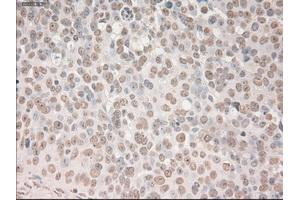 Immunohistochemical staining of paraffin-embedded Adenocarcinoma of breast tissue using anti-SOX17 mouse monoclonal antibody.