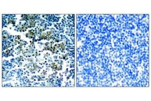 Immunohistochemical analysis of paraffin-embedded human tonsil tumor tissue using Bcr(Phospho-Tyr177) Antibody(left) or the same antibody preincubated with blocking peptide(right). (BCR antibody  (pTyr177))