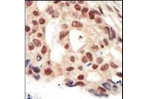 Formalin-fixed and paraffin-embedded human cancer tissue reacted with the primary antibody, which was peroxidase-conjugated to the secondary antibody, followed by AEC staining. (PRKG2 antibody  (C-Term))