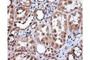 Immunohistochemical staining of paraffin-embedded Carcinoma of liver tissue using anti-MTRF1L mouse monoclonal antibody. (MTRF1L antibody)