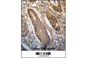 NETO2 Antibody (N-term ) immunohistochemistry analysis in formalin fixed and paraffin embedded human colon carcinoma followed by peroxidase conjugation of the secondary antibody and DAB staining. (NETO2 antibody  (N-Term))