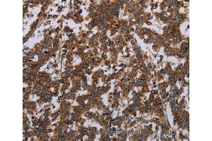 Immunohistochemistry of Human liver cancer using GDF2 Polyclonal Antibody at dilution of 1:40