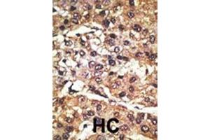 Formalin-fixed and paraffin-embedded human cancer tissue reacted with the primary antibody, which was peroxidase-conjugated to the secondary antibody, followed by DAB staining. (GPR37 antibody  (N-Term))