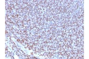 IHC testing of FFPE Ewings sarcoma with recombinant NKX2. (Nkx2-2 antibody  (AA 1-119))