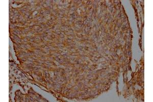 IHC image of ABIN7127493 diluted at 1:100 and staining in paraffin-embedded human cervical cancer performed on a Leica BondTM system. (Recombinant Filamin A antibody)