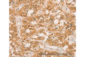 Immunohistochemistry of Human gastric cancer using CPB1 Polyclonal Antibody at dilution of 1:60 (CPB1 antibody)