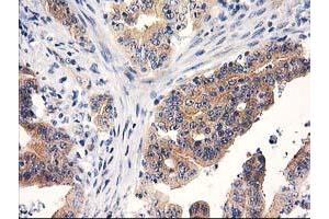 Immunohistochemical staining of paraffin-embedded Adenocarcinoma of Human colon tissue using anti-RTN4IP1 mouse monoclonal antibody. (RTN4IP1 antibody)