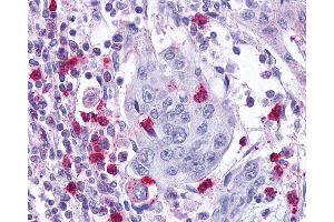 Anti-Leukotriene B4 Receptor / BLT1 antibody IHC of human Pancreas, Carcinoma and Leukocytes. (Leukotriene B4 Receptor/BLT antibody  (Cytoplasmic Domain))