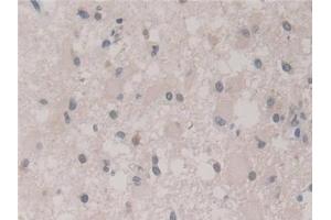 Detection of FIS1 in Human Glioma Tissue using Polyclonal Antibody to Fission 1 (FIS1) (Fission 1 antibody  (AA 1-117))