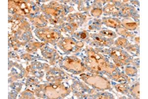 The image on the left is immunohistochemistry of paraffin-embedded Human thyroid cancer tissue using ABIN7128172(ACOX2 Antibody) at dilution 1/20, on the right is treated with fusion protein. (Acox2 antibody)