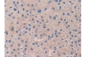 Detection of DHH in Human Liver cancer Tissue using Polyclonal Antibody to Hedgehog Homolog, Desert (DHH) (desert Hedgehog antibody  (AA 241-383))