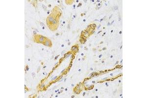 Immunohistochemistry of paraffin-embedded human liver cancer using KIF1B Antibody. (KIF1B antibody  (AA 1501-1770))