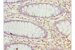 Immunohistochemistry of paraffin-embedded human colon cancer using ABIN7162928 at dilution of 1:100 (Peripherin antibody  (AA 1-260))