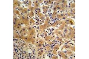 Ceruloplasmin antibody IHC analysis in formalin fixed and paraffin embedded human hepatocarcinoma (Ceruloplasmin antibody  (AA 121-151))