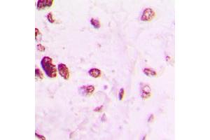 Immunohistochemical analysis of AP2 alpha/beta staining in human lung cancer formalin fixed paraffin embedded tissue section. (AP2 alpha/beta (C-Term) antibody)