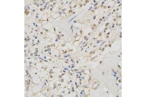 Immunohistochemistry of paraffin-embedded human kidney cancer using MSH2 antibody at dilution of 1:200 (x400 lens). (MSH2 antibody)