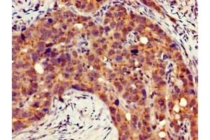 Immunohistochemistry of paraffin-embedded human pancreatic cancer using ABIN7156486 at dilution of 1:100 (Integrin beta 4 antibody  (AA 1401-1533))