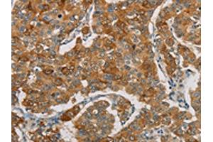 The image on the left is immunohistochemistry of paraffin-embedded Human breast cancer tissue using ABIN7190690(FOXF2 Antibody) at dilution 1/30, on the right is treated with synthetic peptide. (FOXF2 antibody)