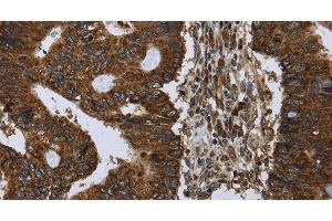 Immunohistochemistry of paraffin-embedded Human colon cancer using PPP1R13L Polyclonal Antibody at dilution of 1:30 (PPP1R13L antibody)