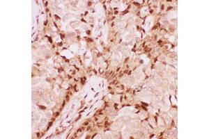 Anti-RUNX1/AML1 Picoband antibody ,  IHC(P): Human Mammary Cancer Tissue (RUNX1 antibody  (Middle Region))