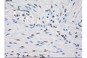Immunohistochemical staining of paraffin-embedded endometrium tissue using anti-IDH1 mouse monoclonal antibody. (IDH1 antibody)